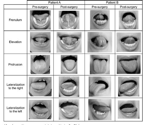 lingual frenectomy vs frenotomy.